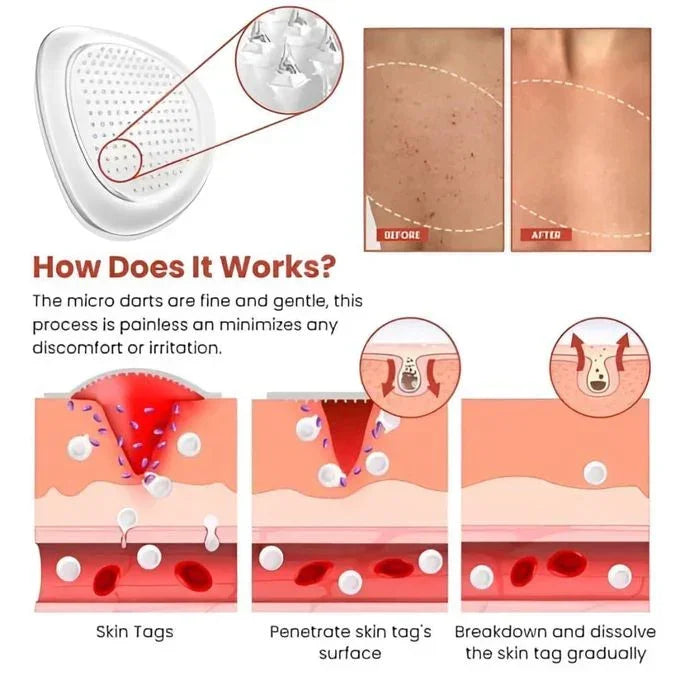 DERMA SMOOTH® SKIN TAG REMOVER PATCH