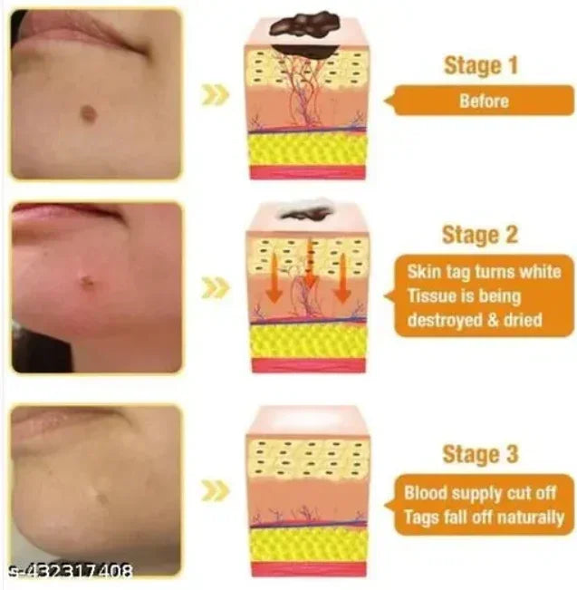DERMA SMOOTH® SKIN TAG REMOVER PATCH