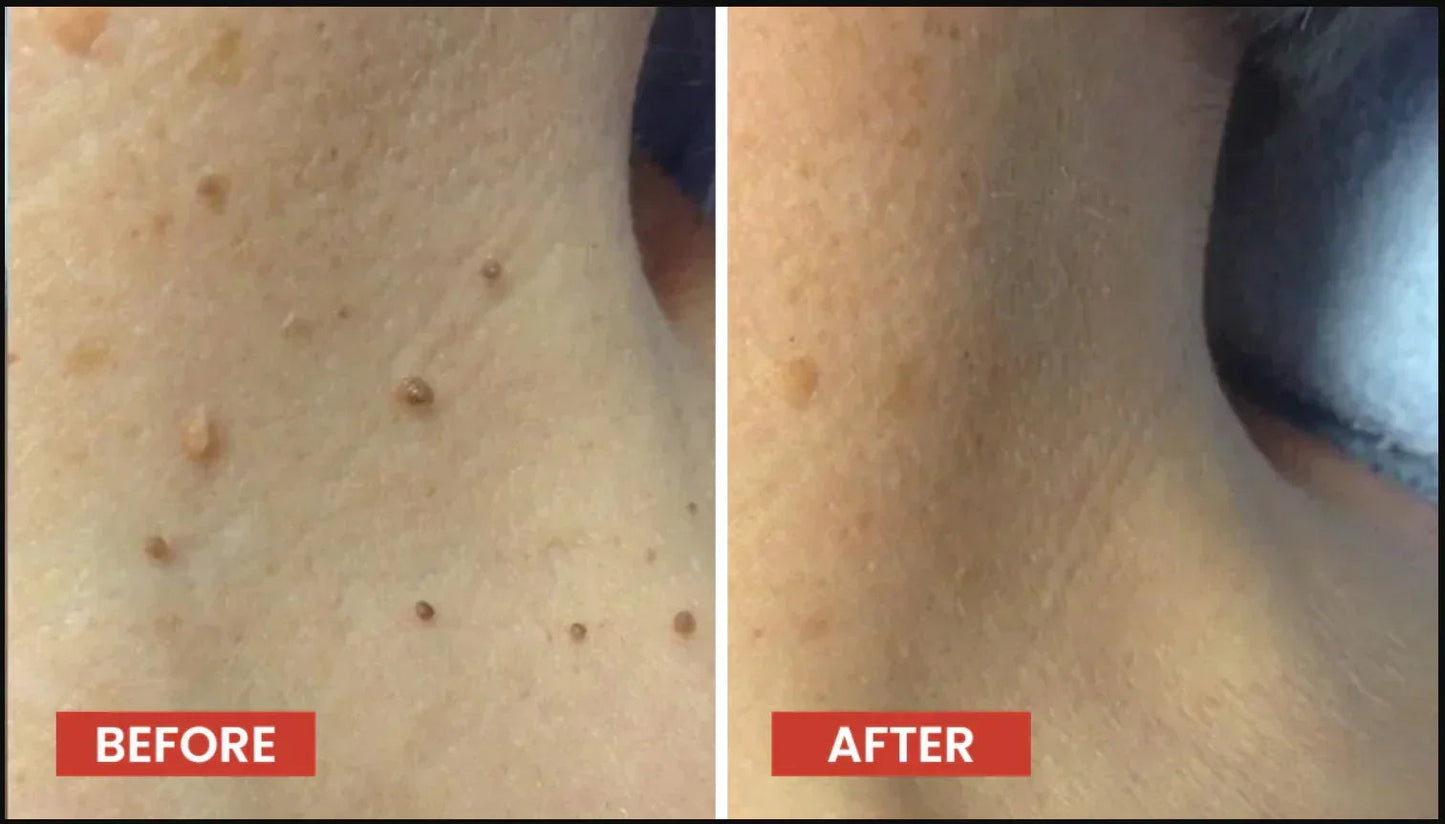 DERMA SMOOTH® SKIN TAG REMOVER PATCH